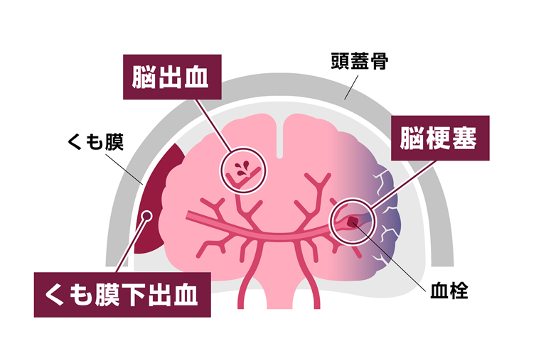 生活習慣病と脳の深い関係